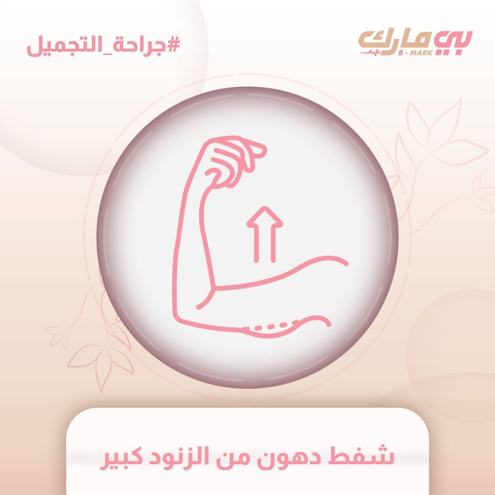 شفط دهون من الزنود كبير