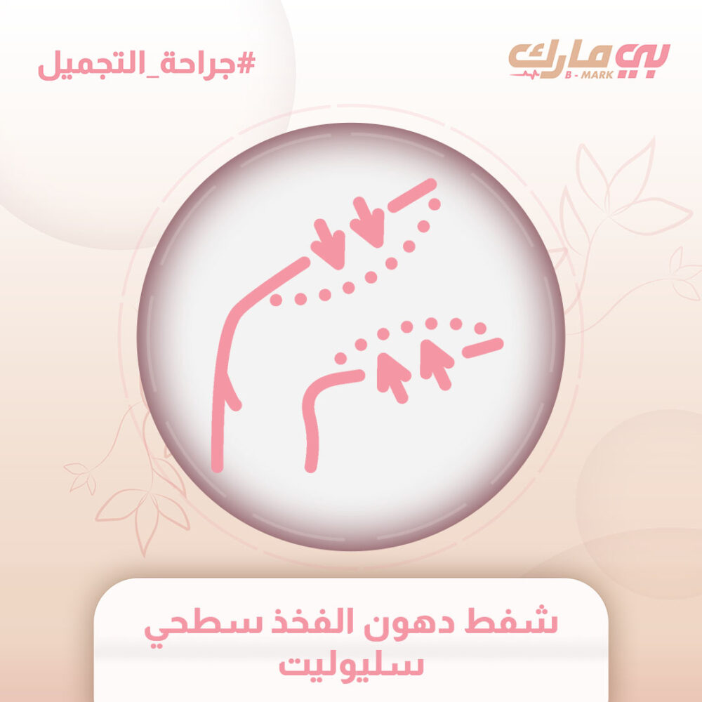 شفط دهون الفخذ سطحي سليوليت