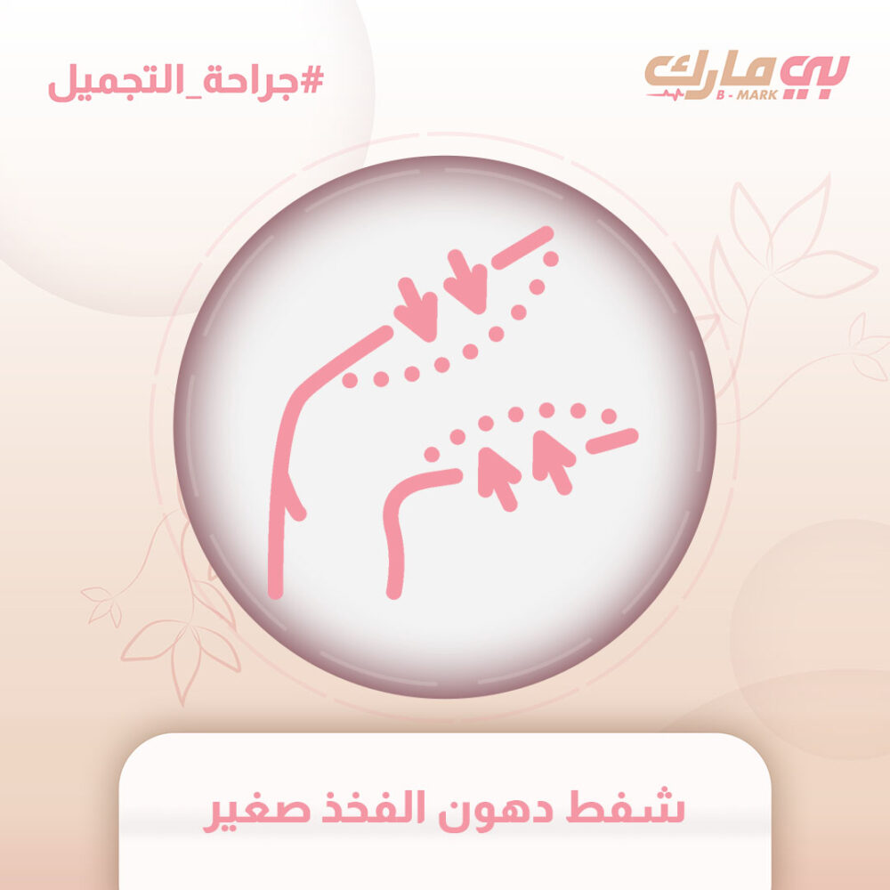شفط دهون الفخذ صغير