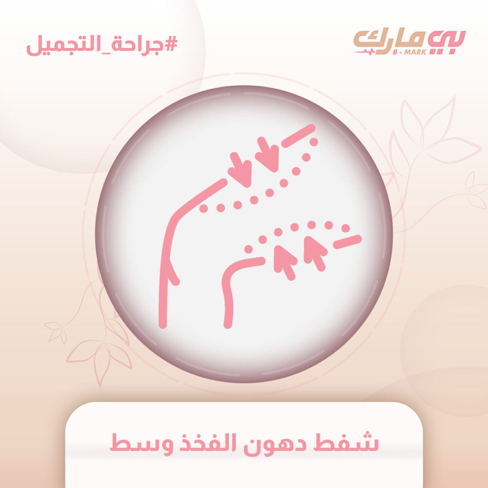 شفط دهون الفخذ وسط