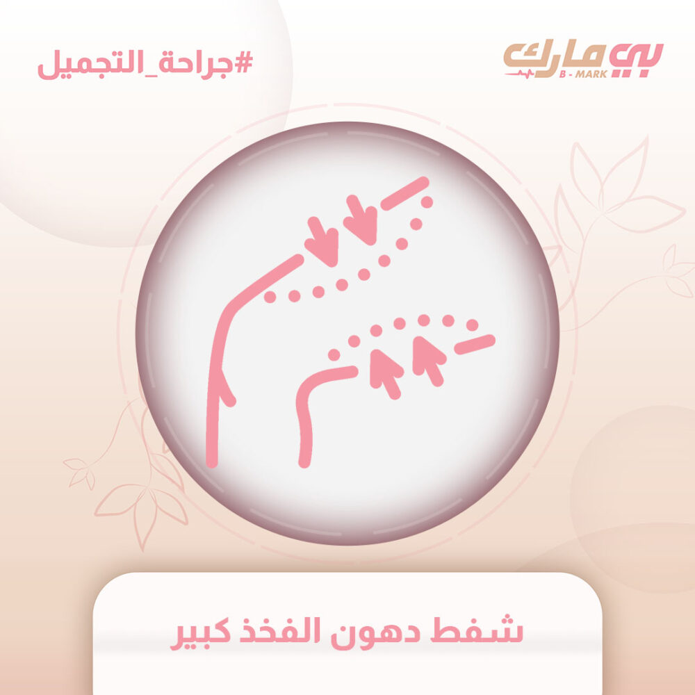 شفط دهون الفخذ كبير
