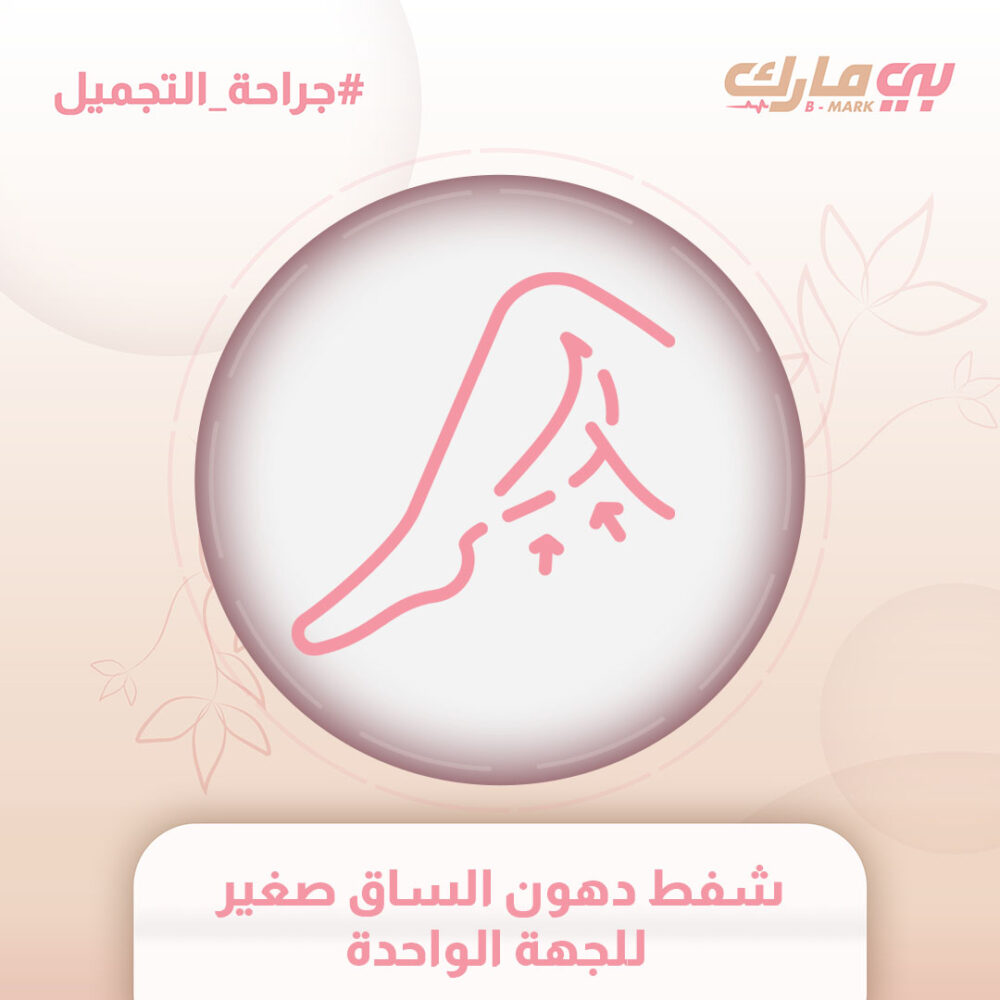 شفط دهون الساق صغير للجهة الواحدة