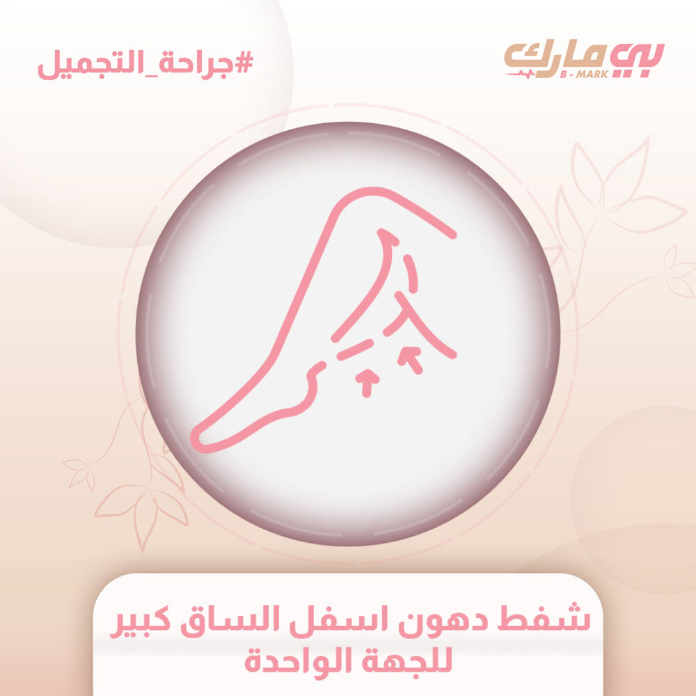 شفط دهون اسفل الساق كبير للجهة الواحدة