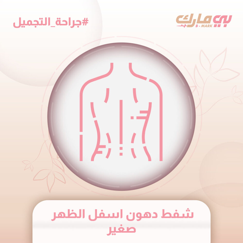 شفط دهون اسفل الظهر صغير