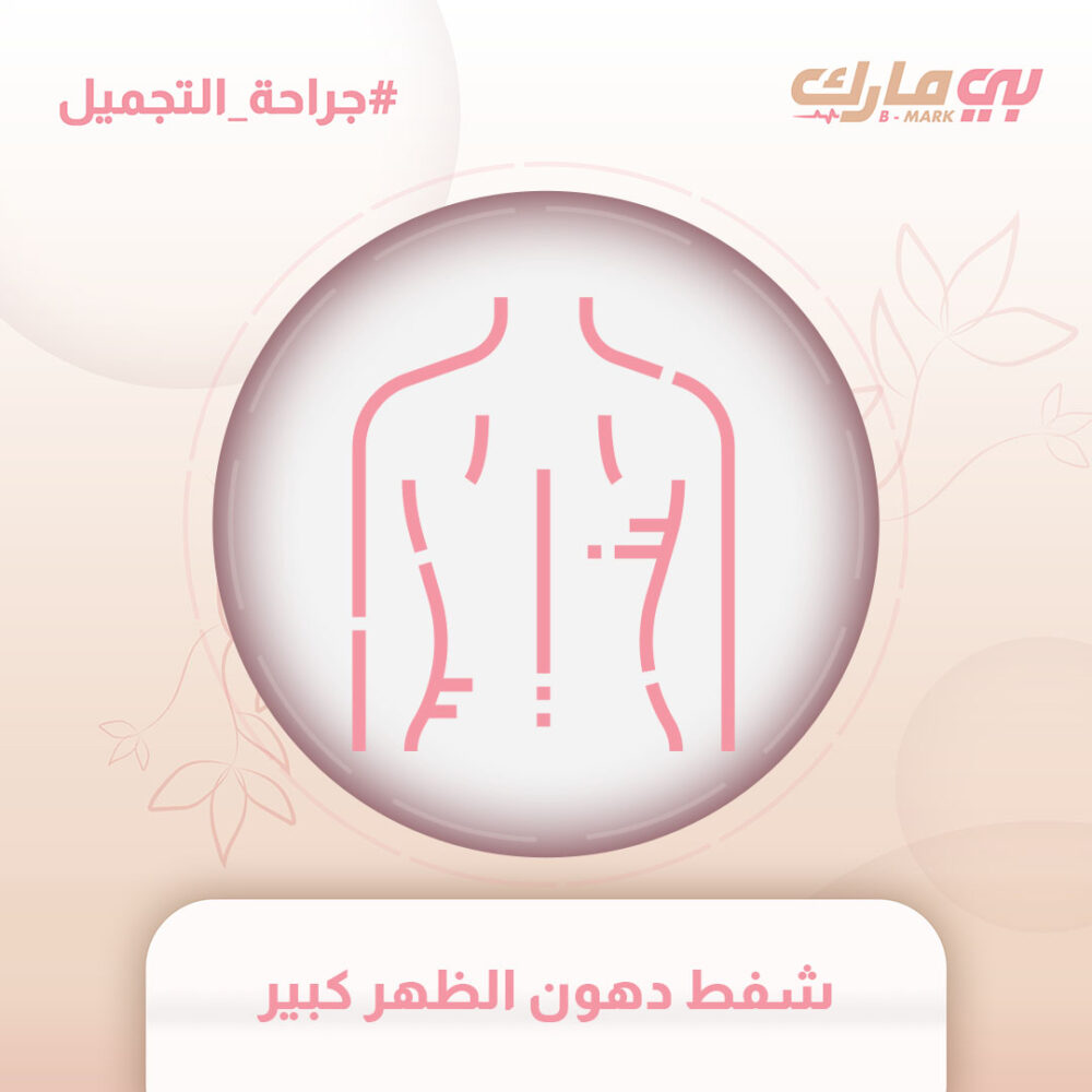شفط دهون الظهر كبير
