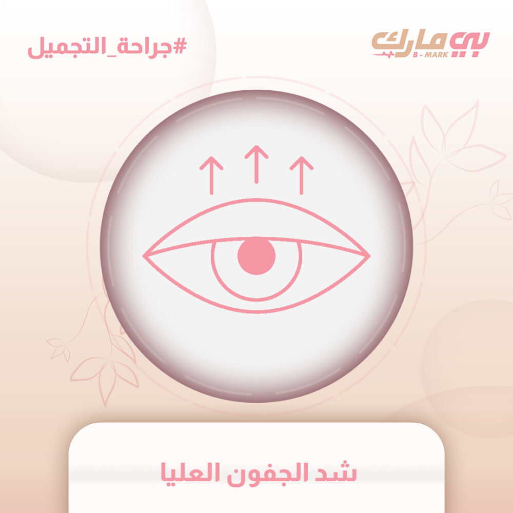 شد الجفون العليا