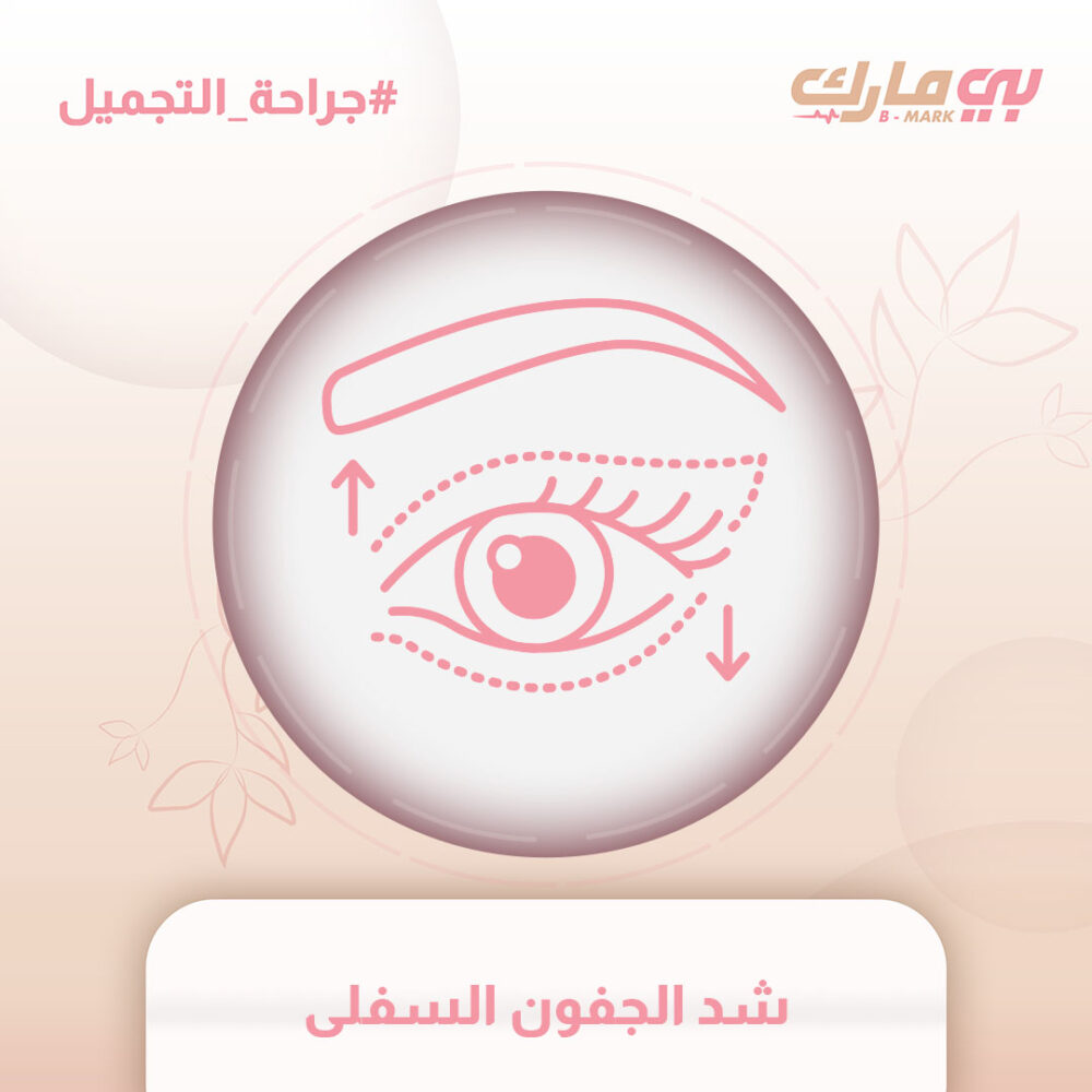 شد الجفون السفلى