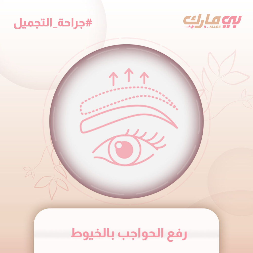 رفع الحواجب بالخيوط