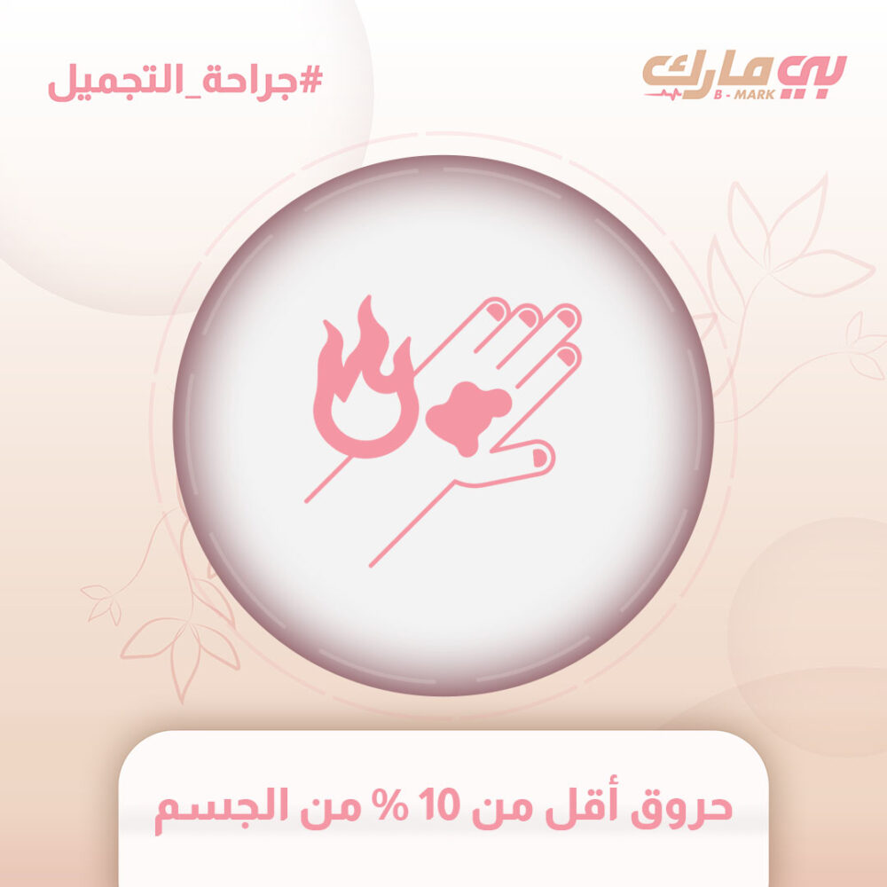 حروق أقل من 10 % من الجسم