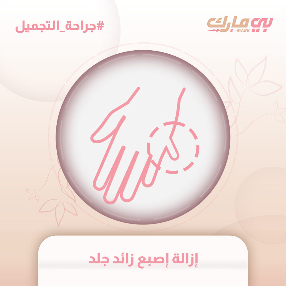 إزالة إصبع زائد جلد