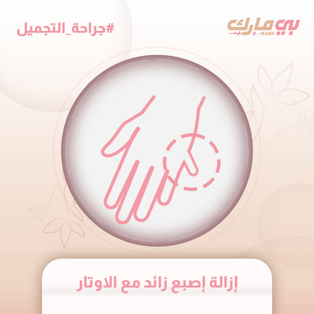 إزالة إصبع زائد مع الاوتار