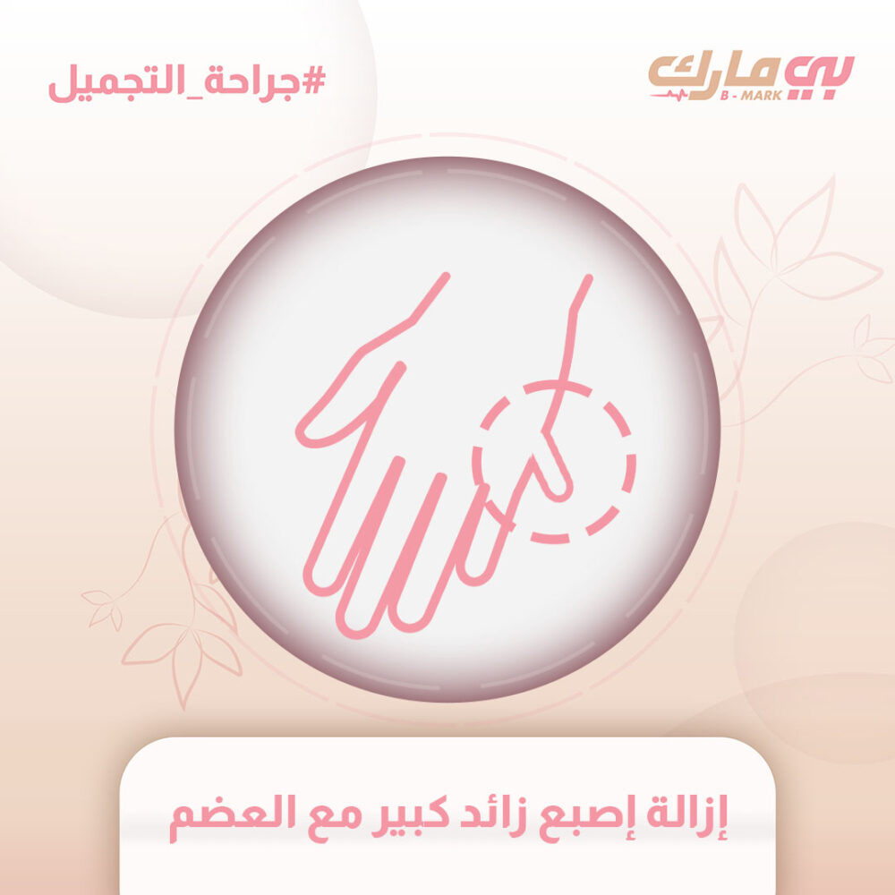 إزالة إصبع زائد كبير مع العضم