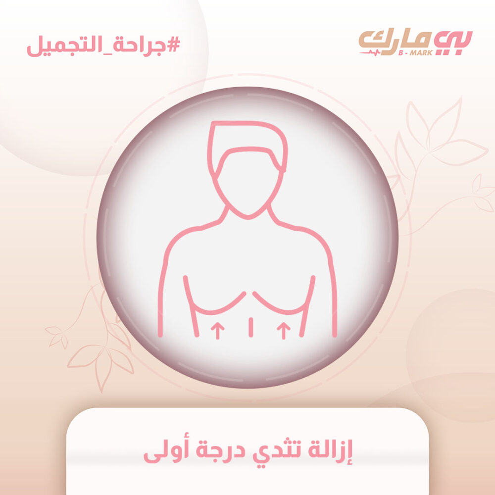 إزالة تثدي درجة أولى