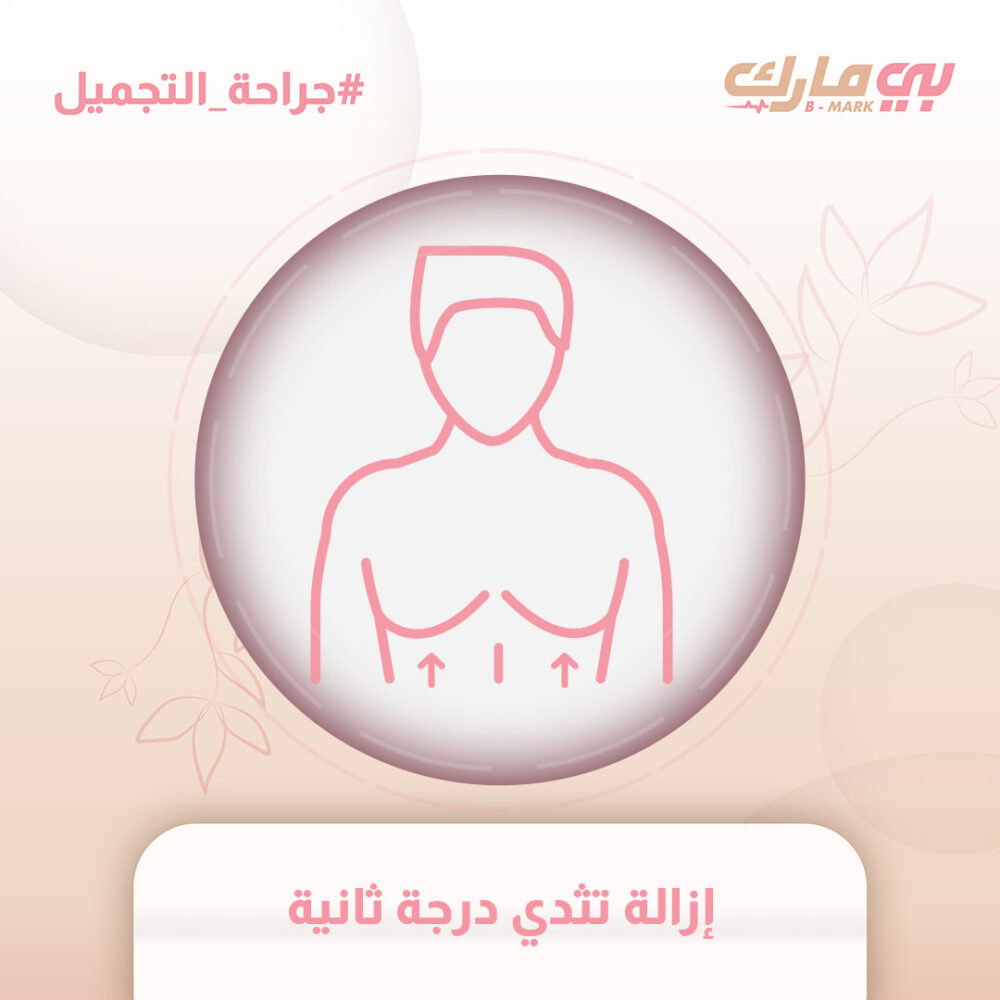 إزالة تثدي درجة ثانية