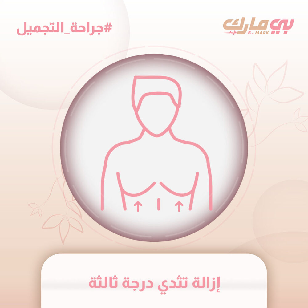 إزالة تثدي درجة ثالثة