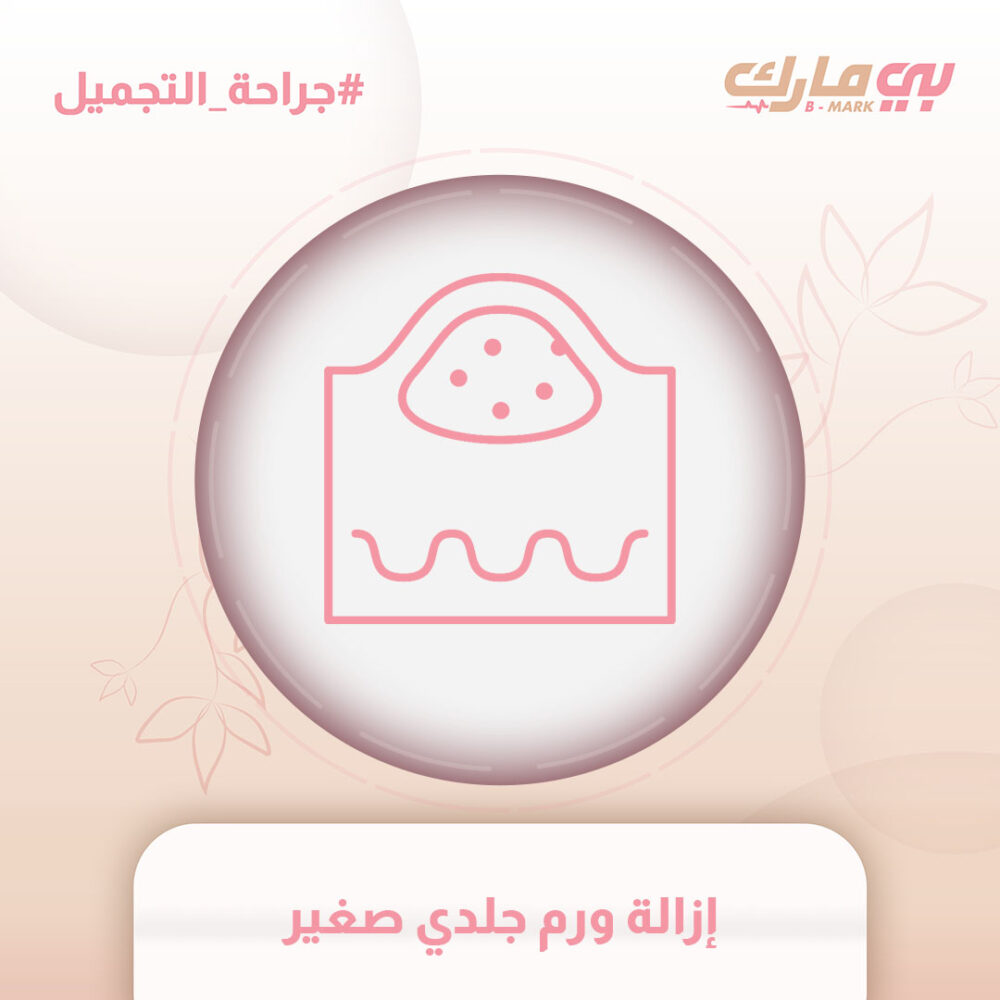 إزالة ورم جلدي صغير