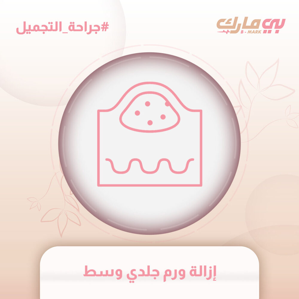 إزالة ورم جلدي وسط