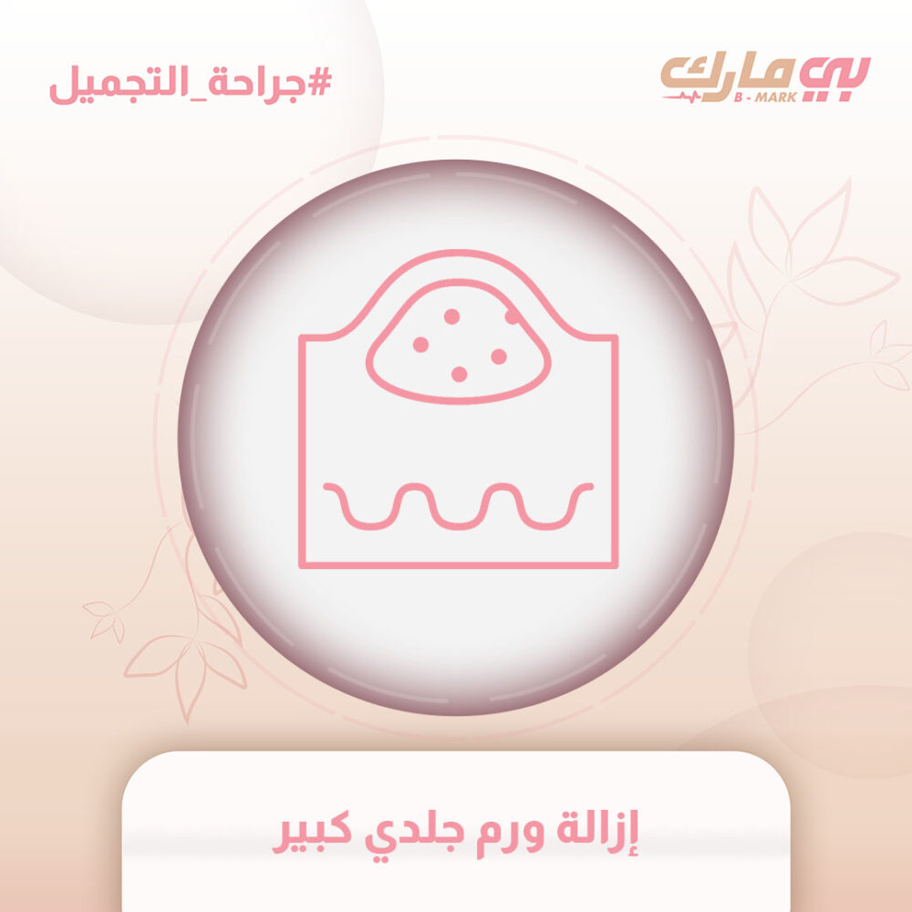 إزالة ورم جلدي كبير