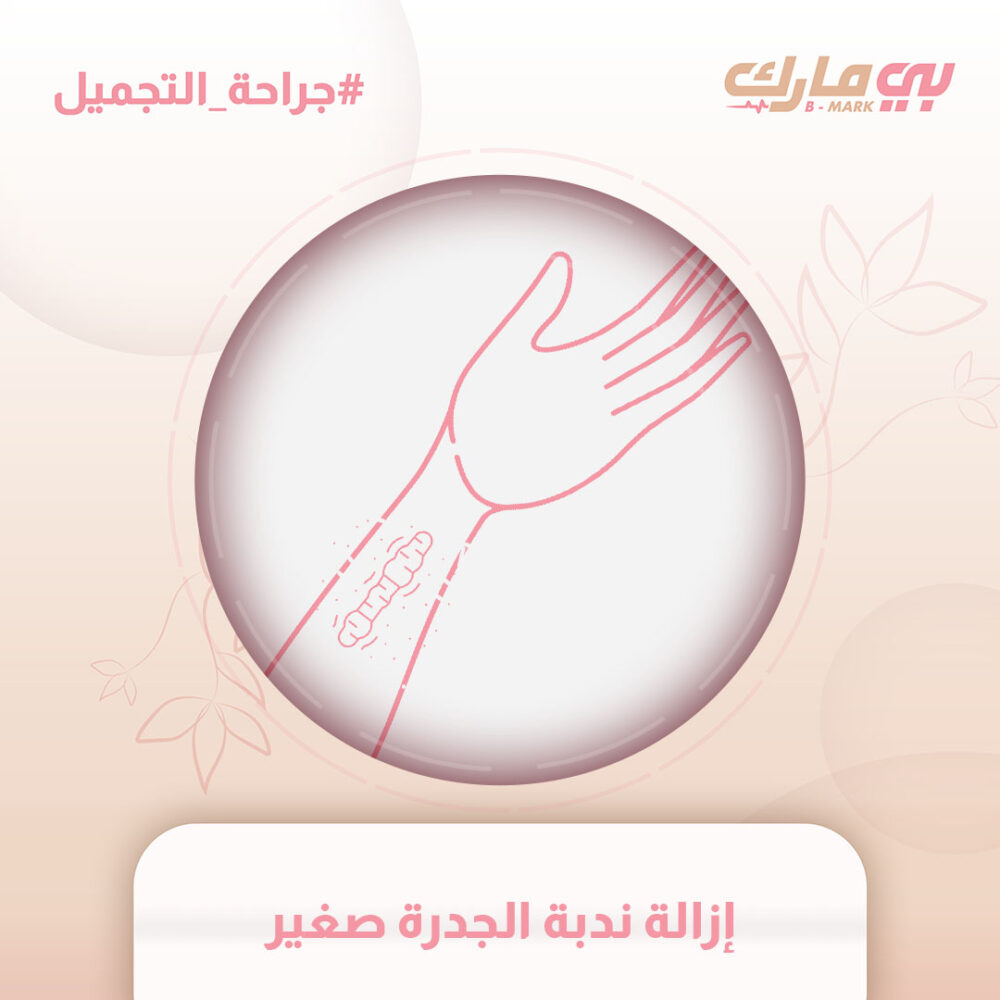 إزالة ندبة الجدرة صغير