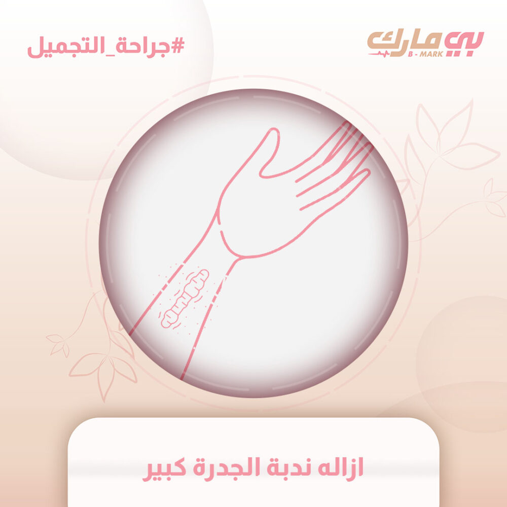 ازاله ندبة الجدرة كبير