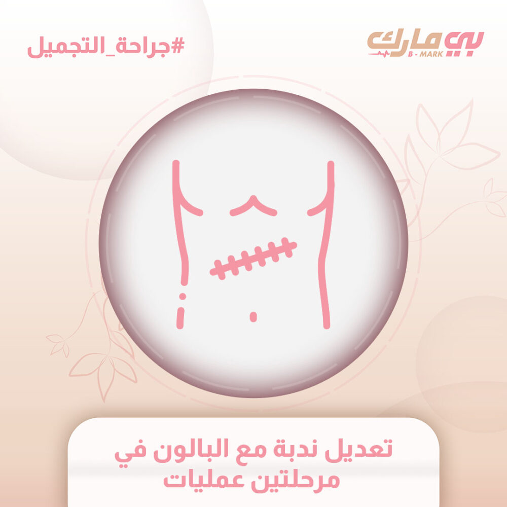 تعديل ندبة مع البالون في مرحلتين عمليات