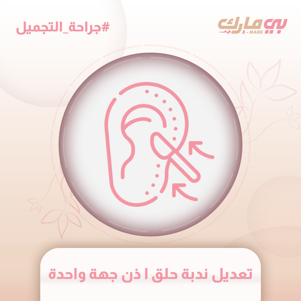 تعديل ندبة حلق ا ذن جهة واحدة